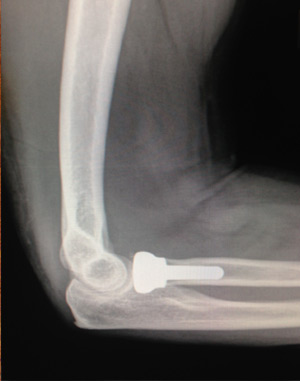 Radial Head Fractures of the Elbow