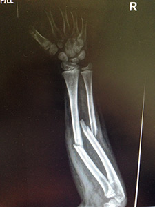 Childs' forearm fracture