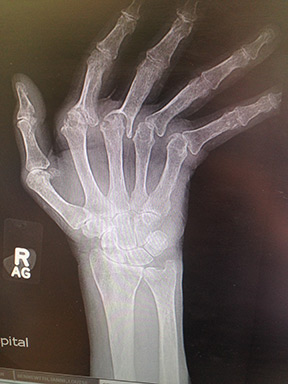 Pre-op Rheumatoid Hand Xray