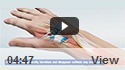 Ganglion Cyst Removal