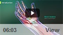 Open Carpal Tunnel Release Surgery