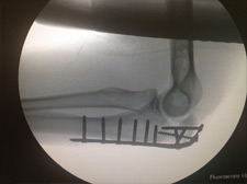 Olecranon (Elbow) Fractures