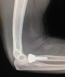 Radial Head Fractures