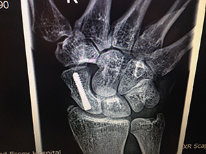 Scaphoid Fracture