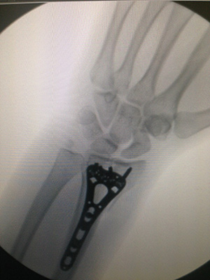 Wrist Fracture