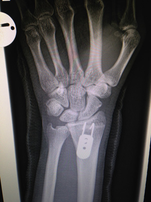 Wrist Fracture