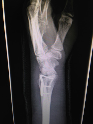 Wrist Fracture