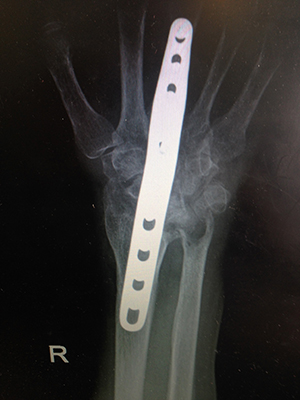 Wrist Arthrodesis/Fusion