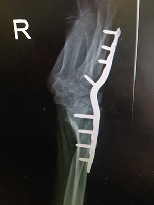 Wrist Arthrodesis/Fusion