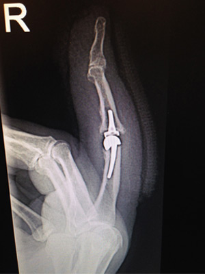 Wrist Arthrodesis/Fusion