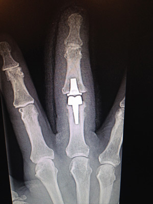 Wrist Arthrodesis/Fusion